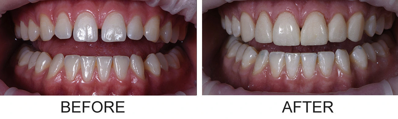 Dental bonding before and after results showing gap closure and alignment improvement