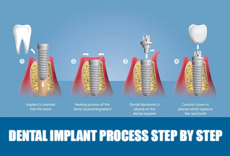 Dental implant process step by step: 1. Implant inserted into bone, 2. Healing and osseointegration, 3. Abutment placement, 4. Ceramic crown placed