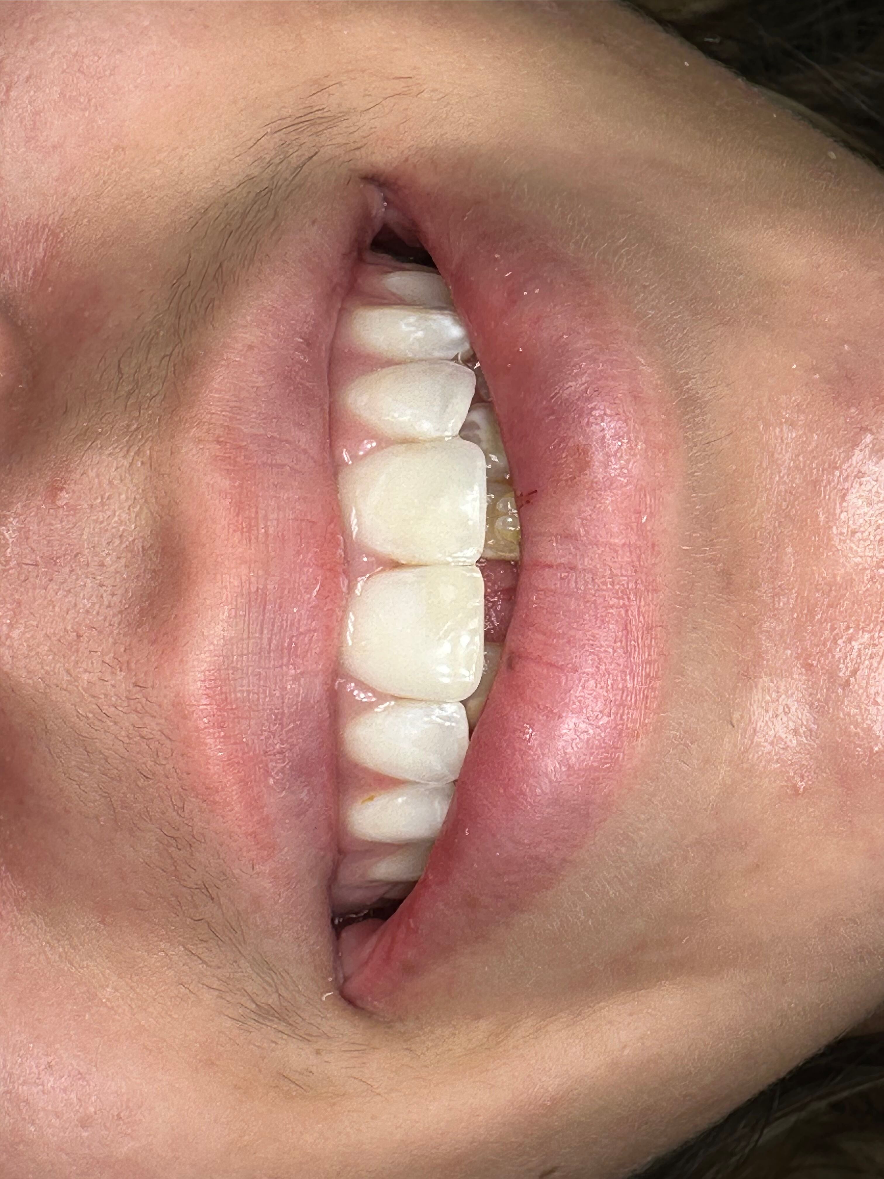 After emergency dental treatment