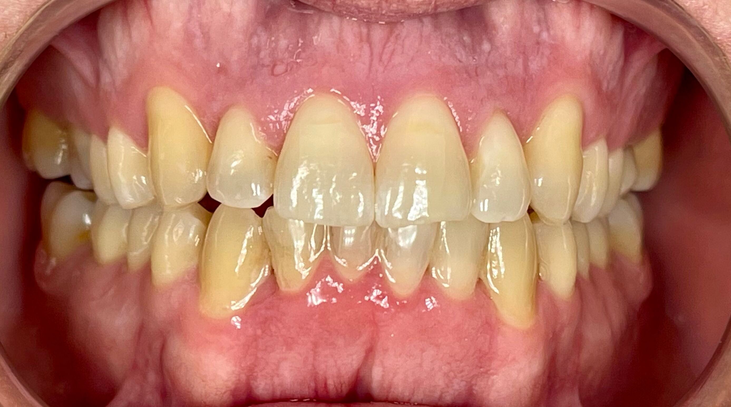 Teeth after Invisalign treatment showing straighter, aligned teeth