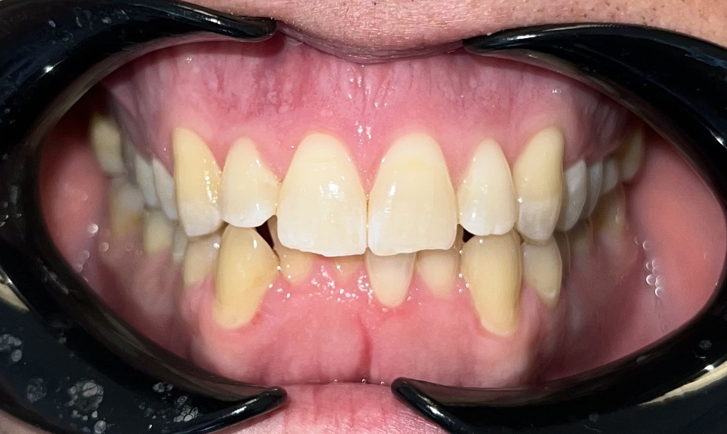 Teeth before Invisalign treatment showing crowding and misalignment