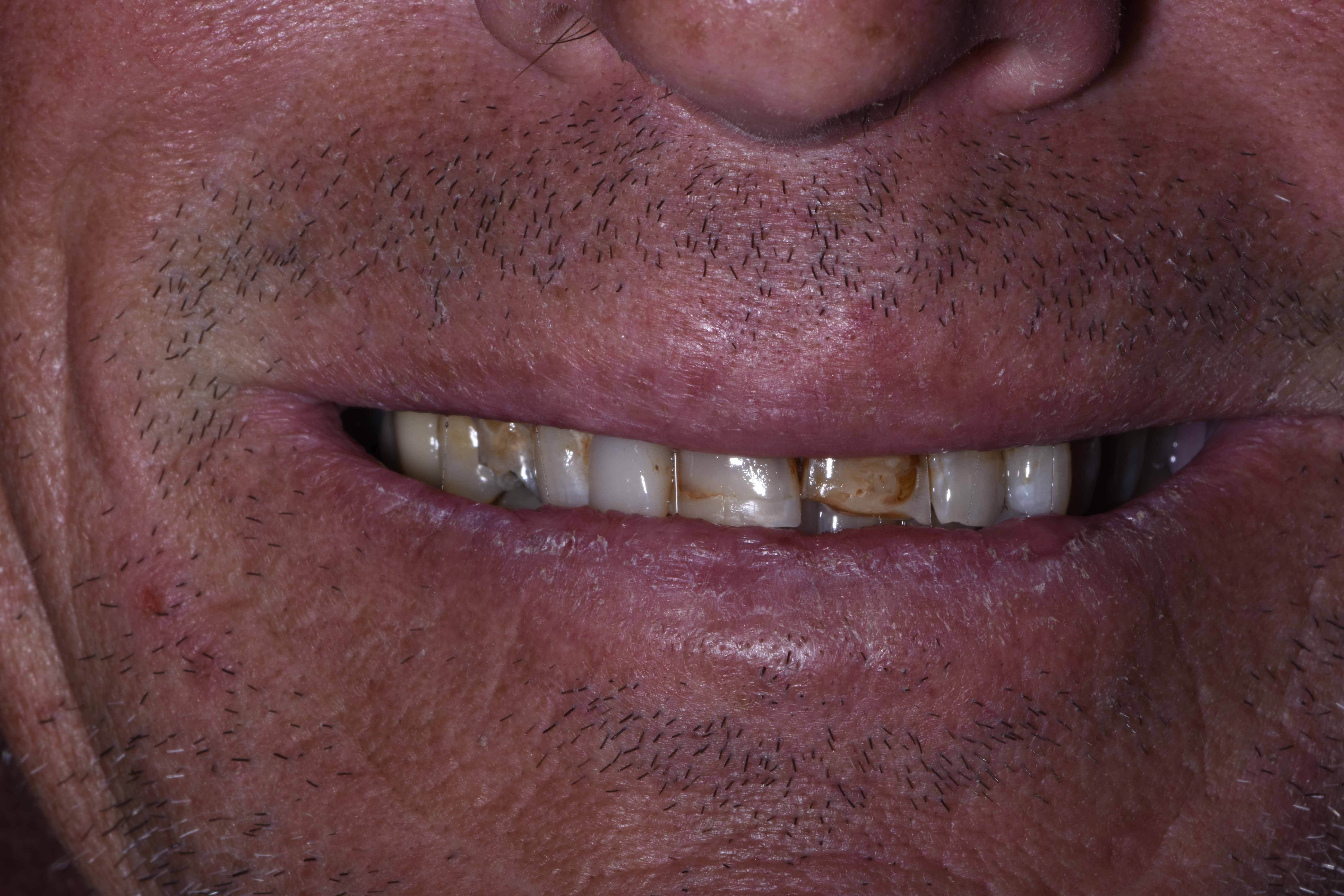 Before porcelain veneers showing discolored and damaged teeth