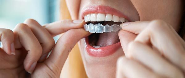 Woman inserting Invisalign clear aligners for orthodontic treatment